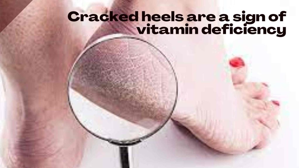 Cracked heels are a sign of vitamin deficiency