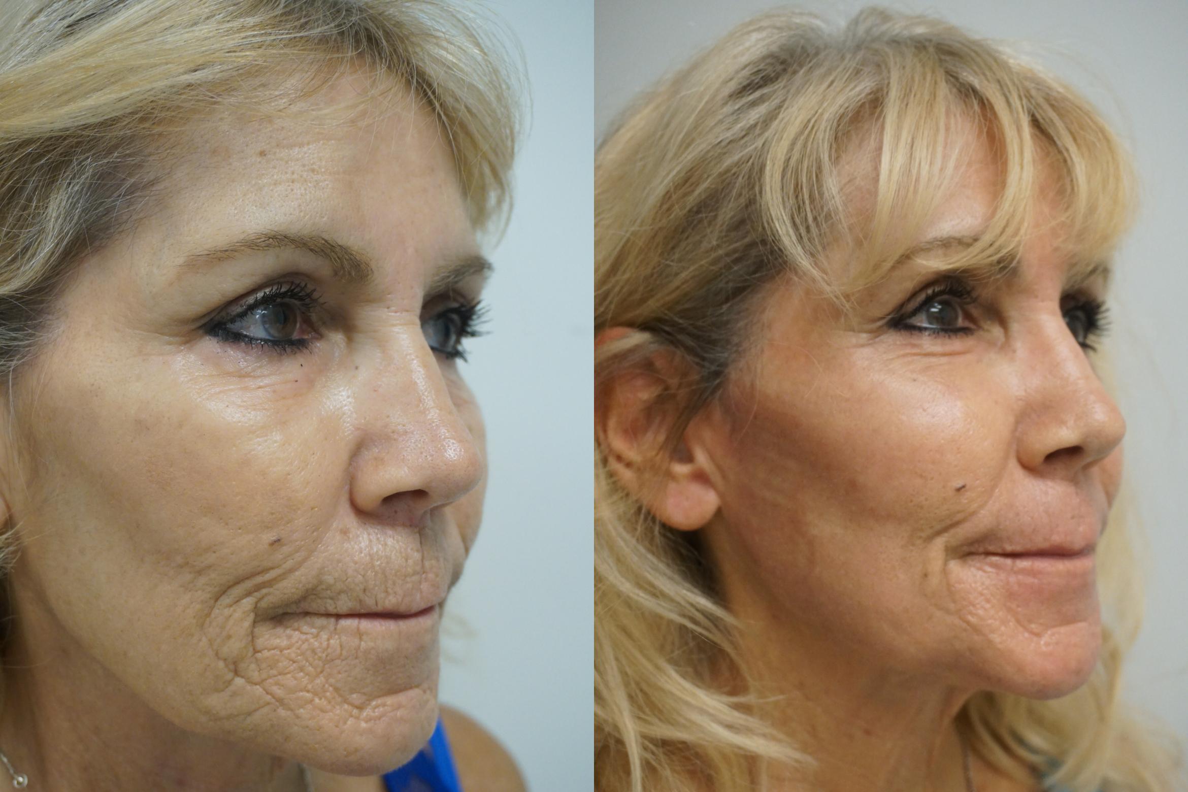 Prepare for Laser Resurfacing and Read the Article to Learn More About Laser Skin Resurfacing