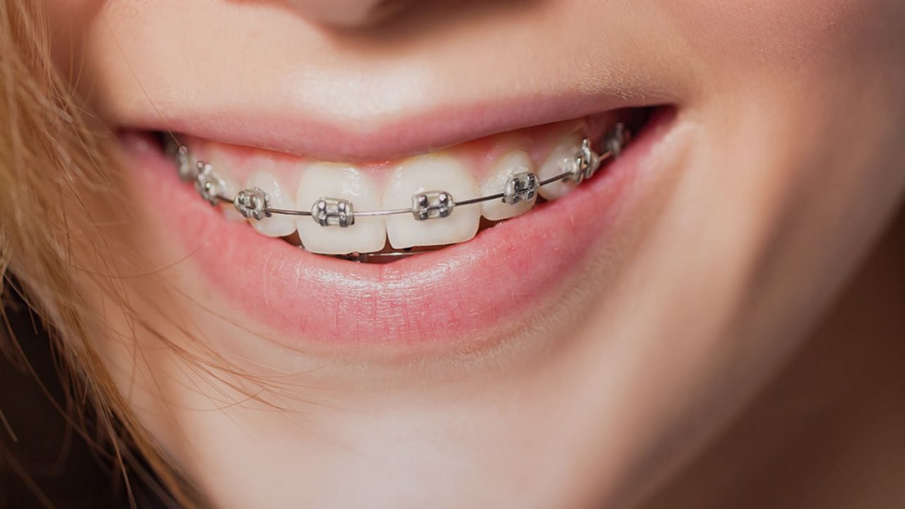 fast braces before and after