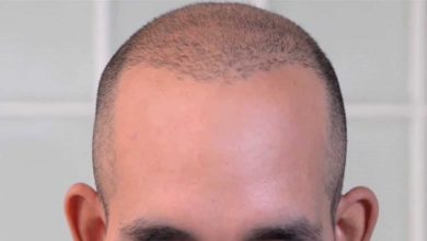 scalp micropigmentation hair loss