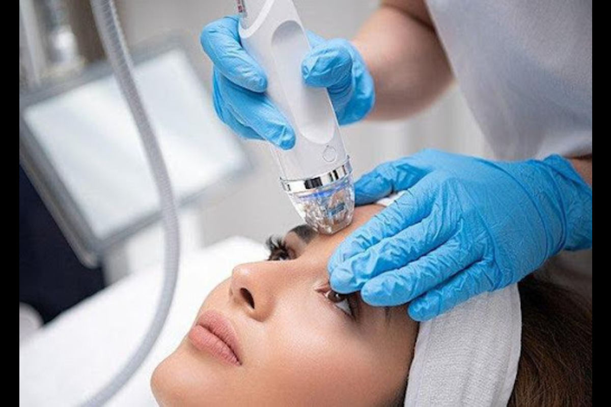 After Microneedling with RF treatment, what can I expect?